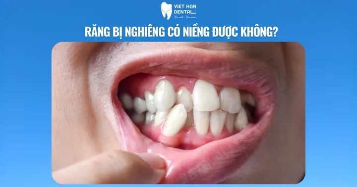 Răng bị nghiêng có niềng được không?