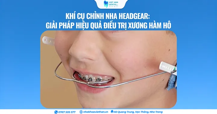 Khí cụ chỉnh nha Headgear: Giải pháp hiệu quả điều trị xương hàm hô