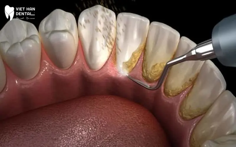 4Vì sao phải cạo vôi răng?&nbsp;