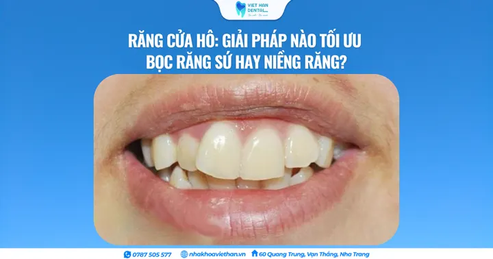Răng cửa hô: Giải pháp nào tối ưu – bọc răng sứ hay niềng răng?