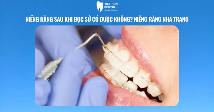 Niềng răng sau khi bọc sứ có được không? Niềng răng Nha Trang