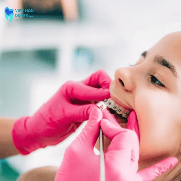 Địa chỉ niềng răng cho con uy tín, an toàn tại Nha Trang