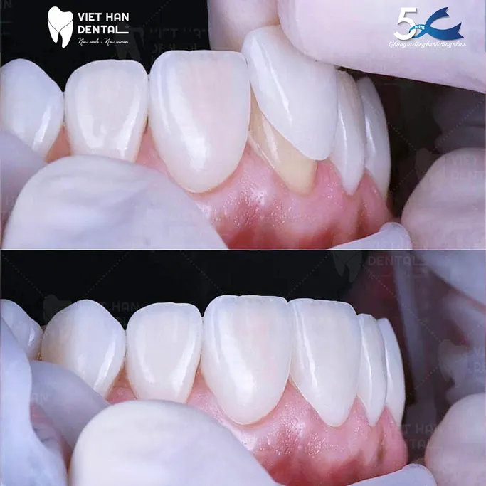 Dan Su Veneer Viet Han