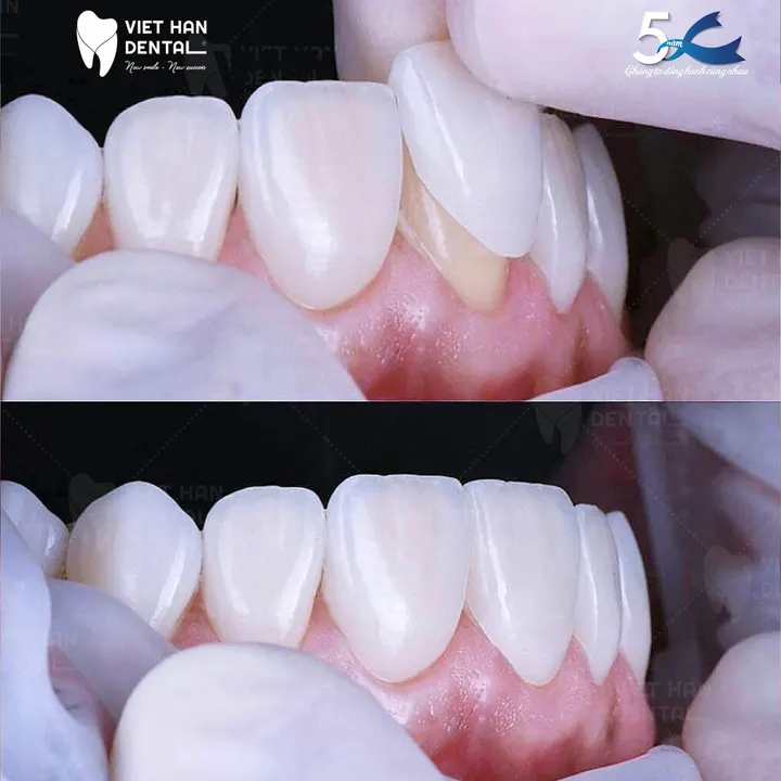 Kinh nghiệm dán sứ veneer mà bạn cần tham khảo