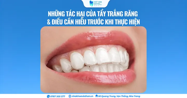 Những tác hại của tẩy trắng răng và Điều cần hiểu trước khi thực hiện