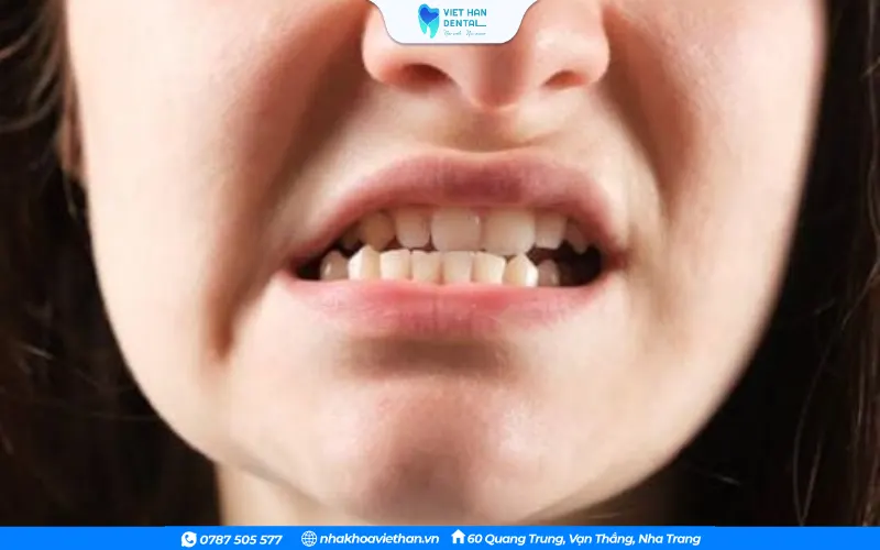 Răng số 7 mất đi sẽ khiến các răng kế cận có xu hướng nghiêng đổ, dẫn đến sai lệch khớp cắn