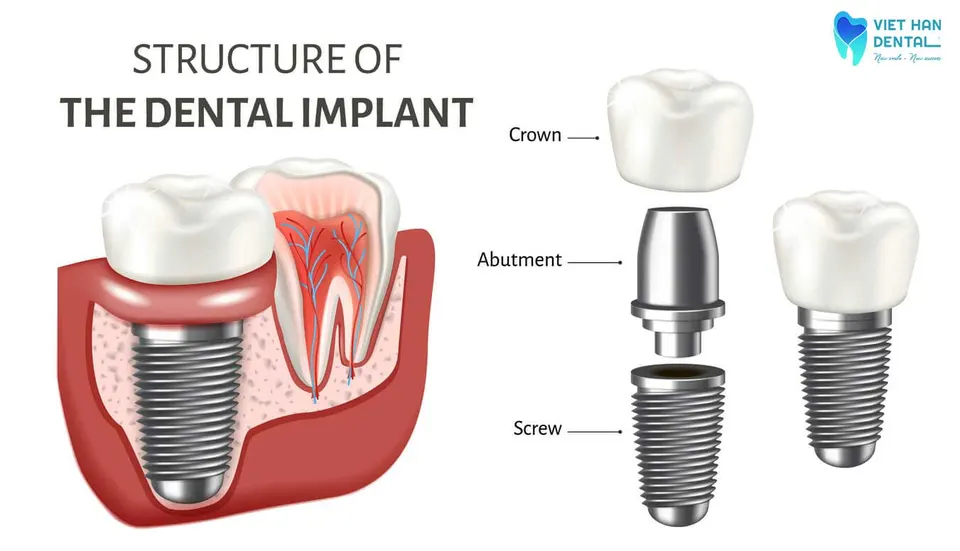 The structure of dental implants 