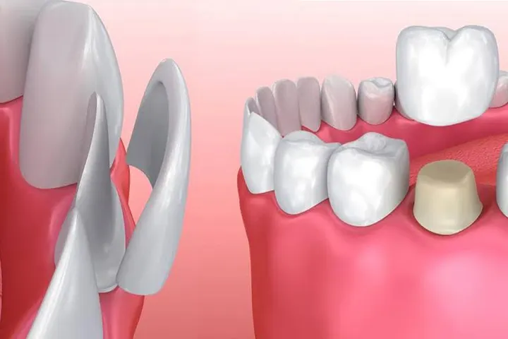 The difference between porcelain crowns and dental veneers