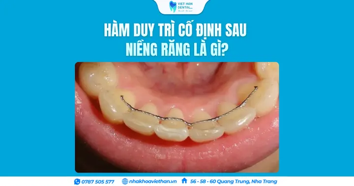 Hàm duy trì cố định sau niềng răng là gì?