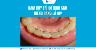 Hàm duy trì cố định sau niềng răng là gì?