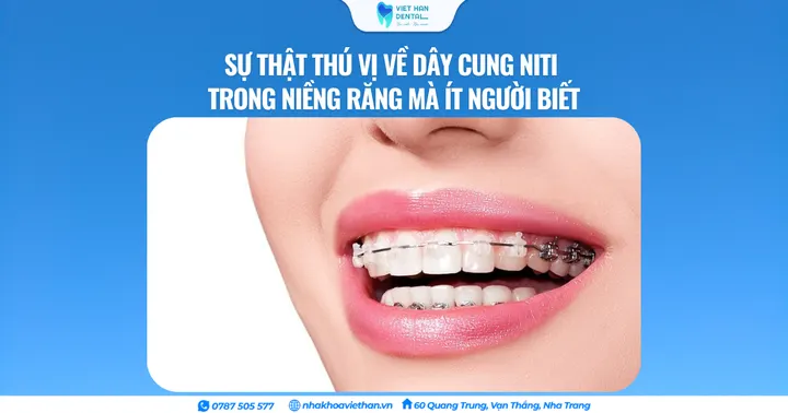 Sự thật thú vị về dây cung NITI trong niềng răng mà ít người biết