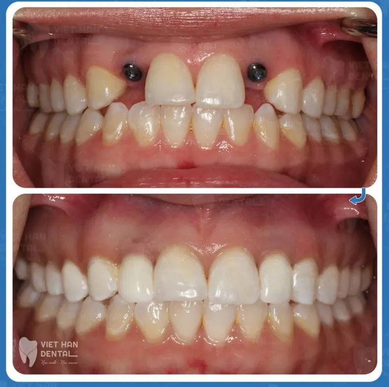 cam-implant-co-dau-khong