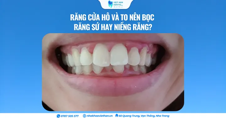 Răng cửa hô và to nên bọc răng sứ hay niềng răng?