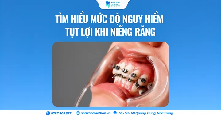Tìm hiểu mức độ nguy hiểm tụt lợi khi niềng răng
