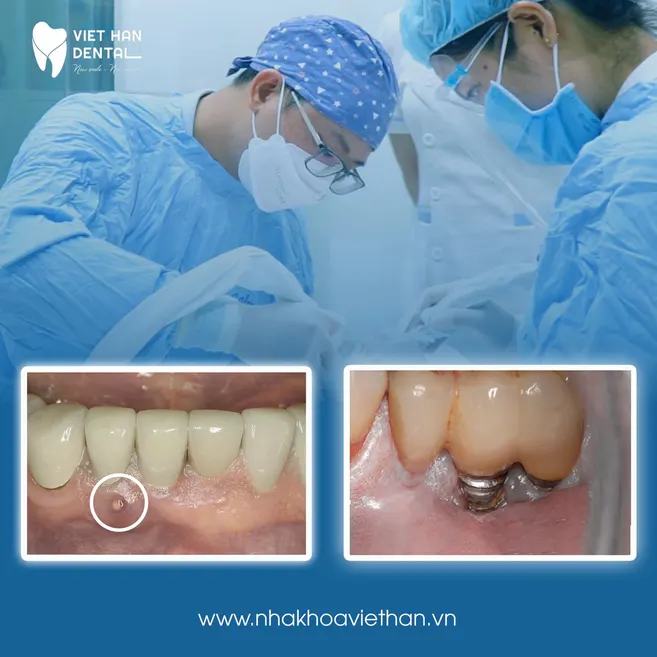 biến chứng khi trồng răng implant giá rẻ 