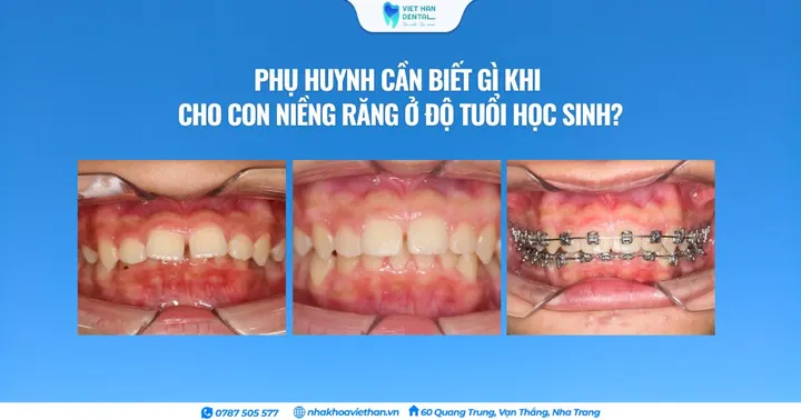 Phụ huynh cần biết gì khi cho con niềng răng ở độ tuổi học sinh?
