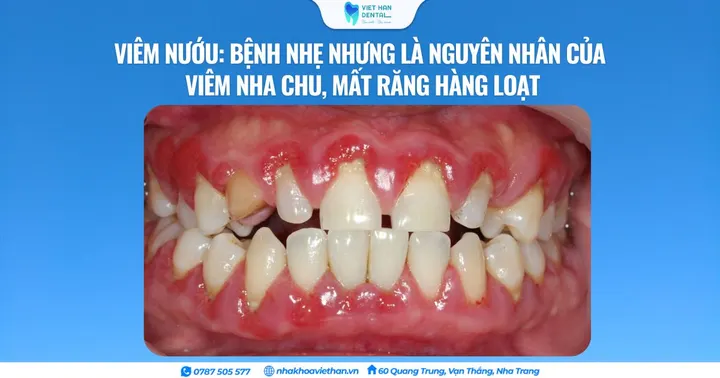 Viêm nướu: Bệnh nhẹ nhưng là nguyên nhân của viêm nha chu, mất răng hàng loạt