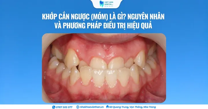 Khớp cắn ngược (móm) là gì? Nguyên nhân và phương pháp điều trị hiệu quả