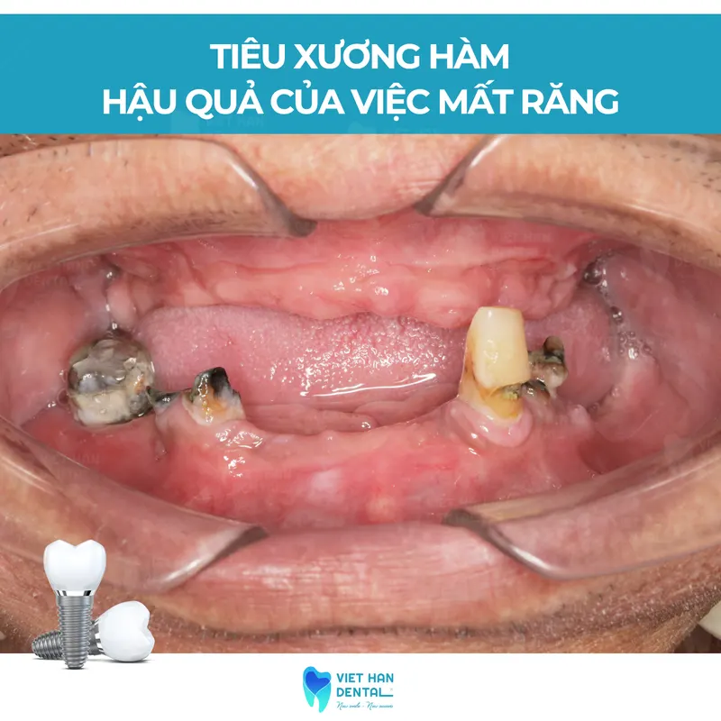 truong-hop-nao-nen-cay-ghep-implant-nha-khoa-viet-han