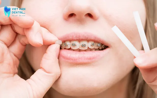 Sử dụng sáp nha khoa