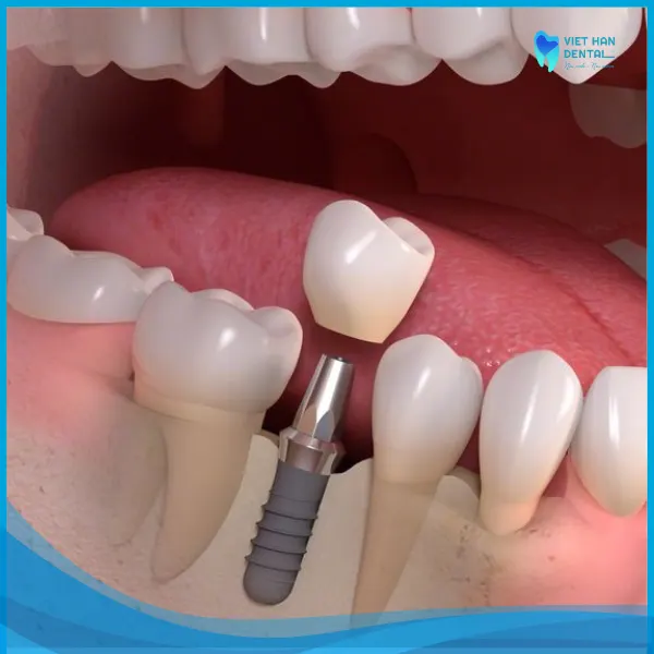 Trụ Implant, sau khi đã tích hợp vào xương