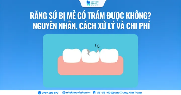 Răng sứ bị mẻ có trám được không? Nguyên nhân, cách xử lý và chi phí