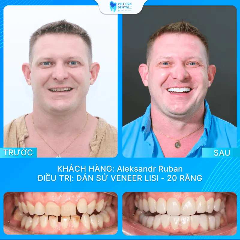 Anh Aleksandr Ruban trước và sau khi dán sứ Veneer Lisi (20 răng)