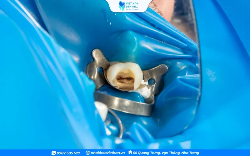 Điều trị tủy và bọc răng sứ có thể giúp sử dụng răng sứ trong 10-20 năm