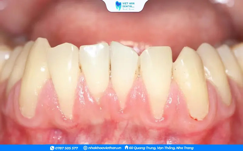 Nướu bị sưng tấy, không ôm sát chân răng là dấu hiệu của tụt lợi