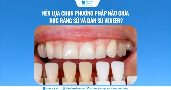 Nên lựa chọn phương pháp nào giữa bọc răng sứ và dán sứ Veneer?