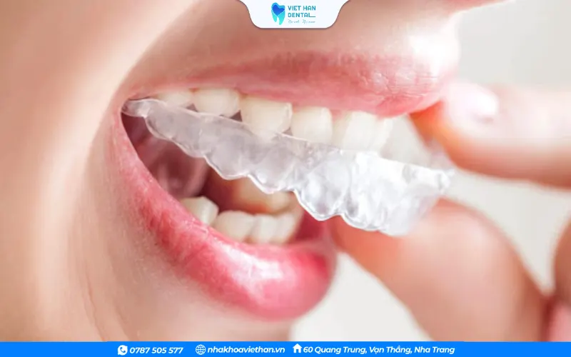 Niềng răng trong suốt