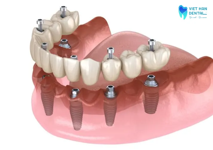 Trồng răng implant all on 6