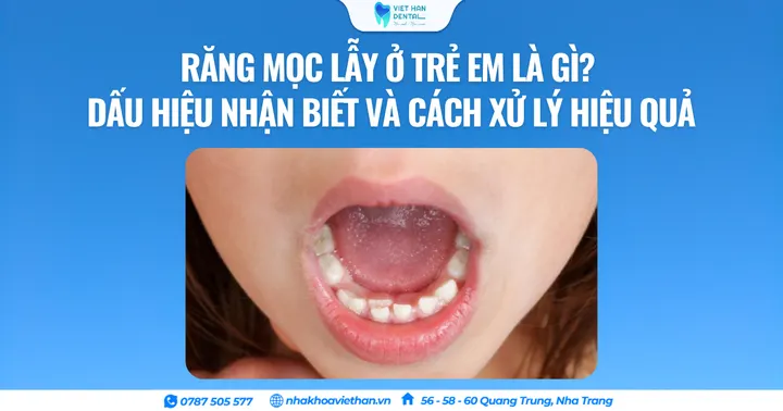 Răng mọc lẫy ở trẻ em là gì? Dấu hiệu nhận biết và cách xử lý hiệu quả