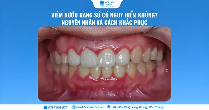 Viêm Nướu Răng Sứ Có Nguy Hiểm Không? Nguyên Nhân Và Cách Khắc Phục