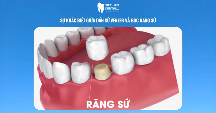 Sự khác biệt giữa dán sứ Veneer và bọc răng sứ