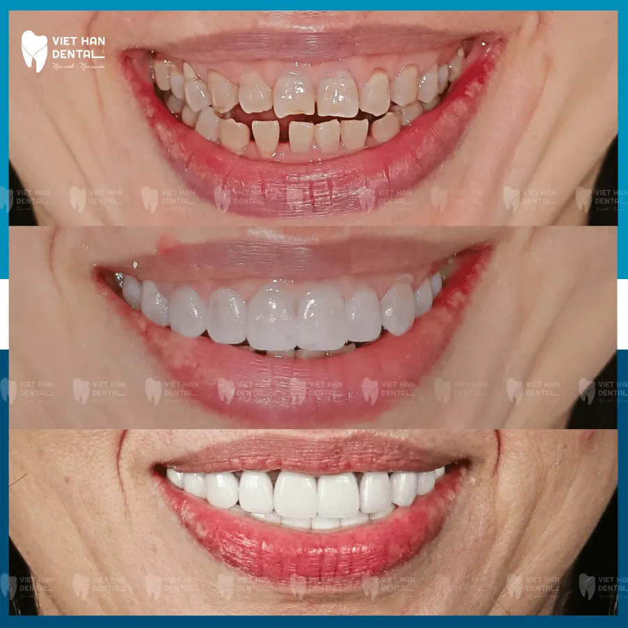 Khách hàng nói gì về kết quả phục hình răng sứ thẩm mỹ tại Nha khoa Việt Hàn?