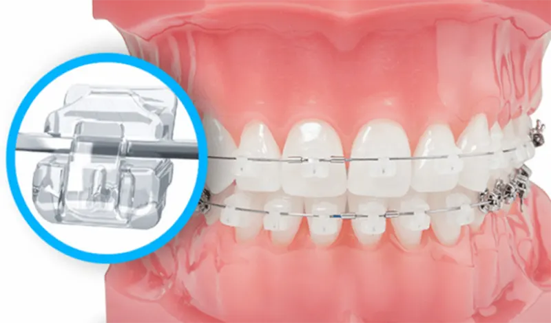 Ceramic Self-Ligating Braces