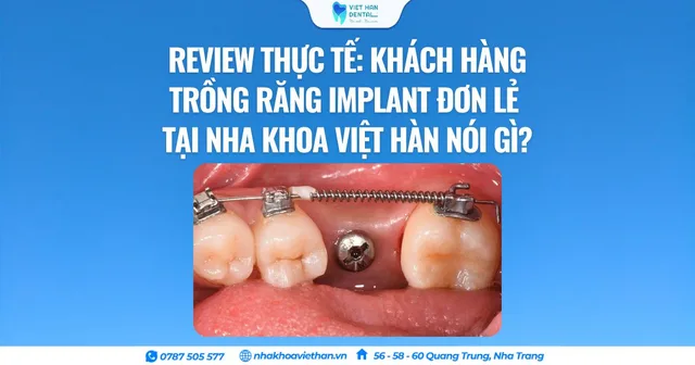 Hành trình trồng Implant đơn lẻ tại Nha khoa Việt Hàn