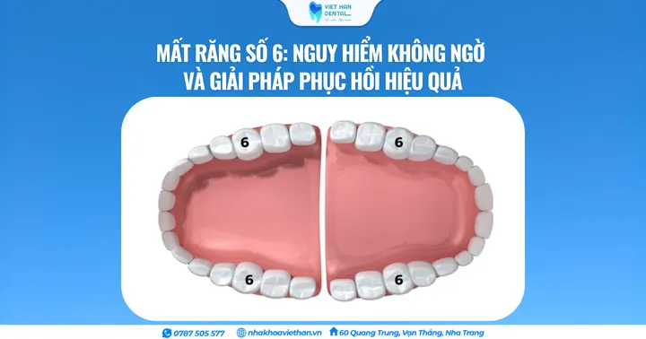 Mất răng số 6: Nguy hiểm không ngờ và giải pháp phục hồi hiệu quả