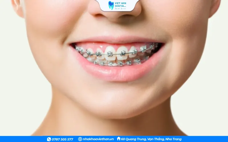 Niềng răng mắc cài