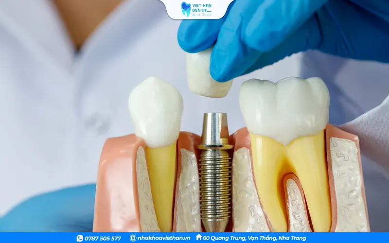 Phương pháp trồng răng Implant