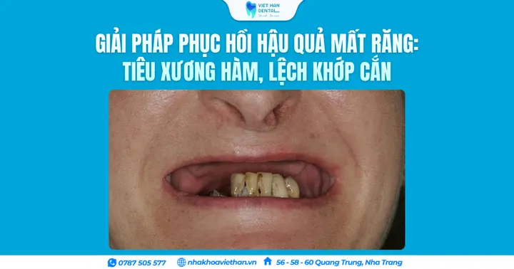 Giải pháp phục hồi hậu quả mất răng: Tiêu xương hàm, lệch khớp cắn