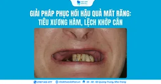 Giải pháp phục hồi hậu quả mất răng: Tiêu xương hàm, lệch khớp cắn