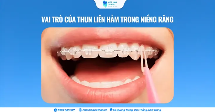 Vai trò của thun liên hàm trong niềng răng