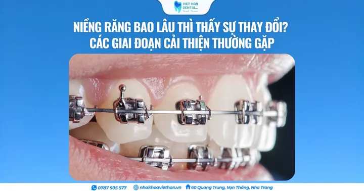 Niềng răng bao lâu thì thấy sự thay đổi? Các giai đoạn cải thiện thường gặp