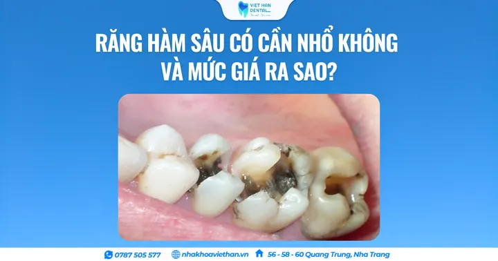 Răng hàm sâu có cần nhổ không và chi phí thực hiện?