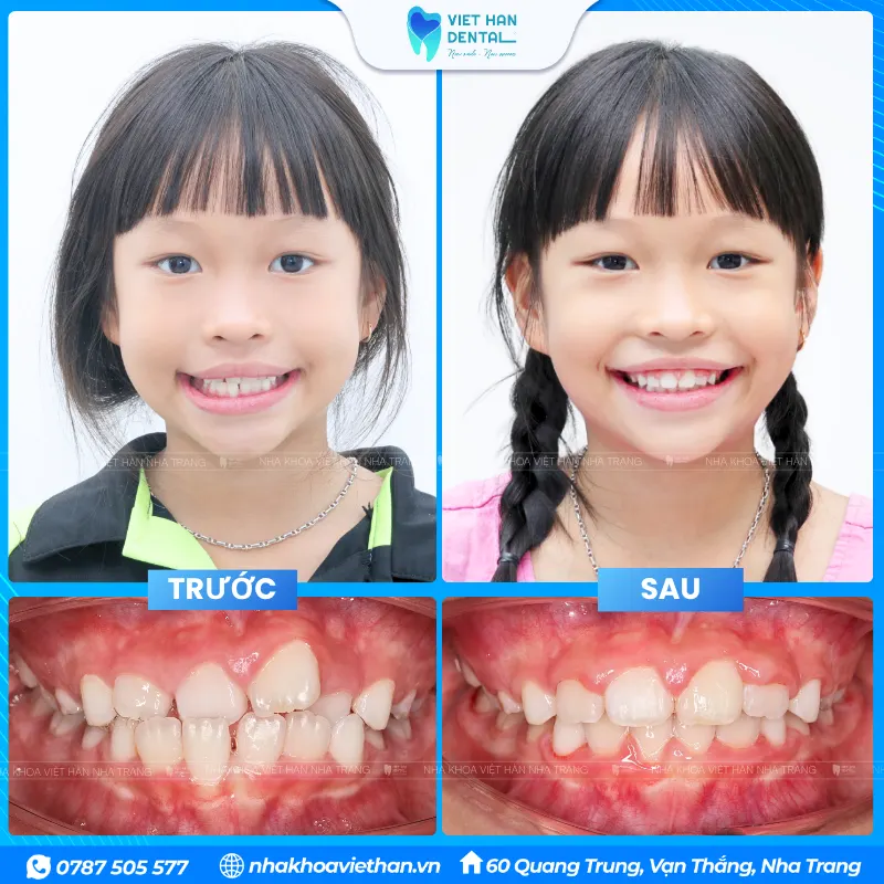 Tiền chỉnh nha ở trẻ em