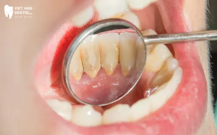 Dental Cleaning