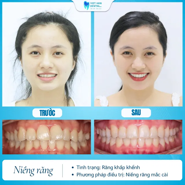 Khách hàng trước và sau khi niềng răng tại Nha khoa Việt Hàn
