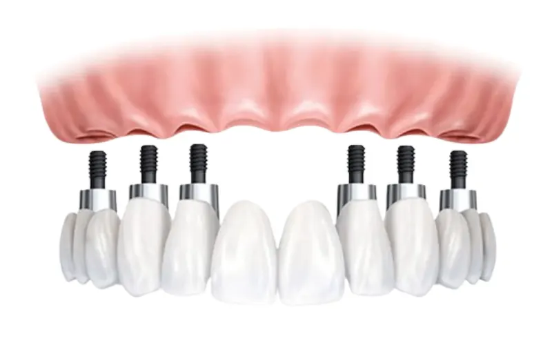 Who is a candidate for All-on-6 dental implants
